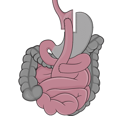 Gastric bypass surgery