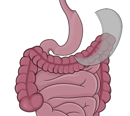 Gastric sleeve surgery