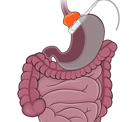bariatric revision surgery