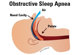 obstructive sleep apnea