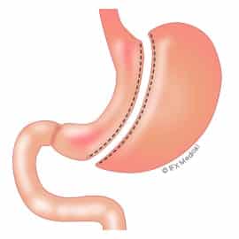 sleeve gastrectomy 2